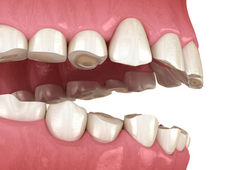 Dental attrition (Bruxism) resulting in loss of tooth tissue.  Medically accurate tooth 3D illustration