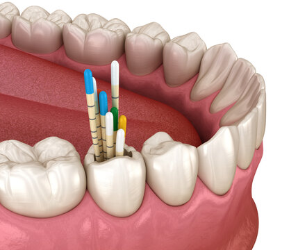 Gutta percha root canal treatment process. Medically accurate tooth 3D illustration
