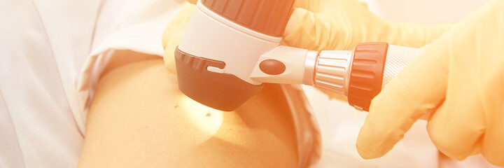 Check mole at hospital. Doctor hands in gloves. special equipment. Medical device for test...