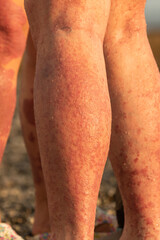 Fototapeta premium red spots on the skin of the feet