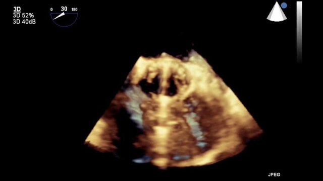 Transesophageal ultrasound video in 3D mode.