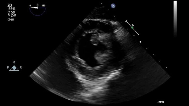 Transesophageal ultrasound video in gray-scale mode.