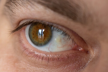 Fototapeta premium Pinguecula eyes macro photo close-up of the male eye. Yellow education on squirrel, farmer's eye