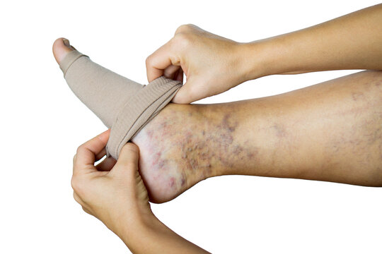a woman puts a compression stocking on her leg with varicose veins. Varicose veins prevention, Compression tights, relief for tired legs. female legs in stockings.