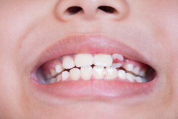 Tooth decay and gum problems of children.