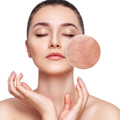 Young woman with couperose on face skin.