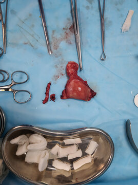 Concept of gynecology surgery. Female uterus is near scalpel, scissors and kidney basin. Surgery in gynecology and operation on uterus, ovaries or fallopian tubes such hysterectomy or myomectomy.