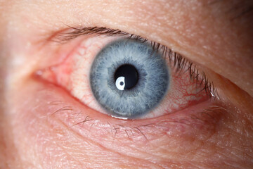 Irritated left blue male eye full with red capillar net