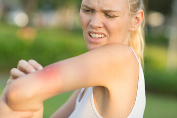 Itchy mosquito bite. Annoyed female person scratching her painful red swollen insect bite on her...