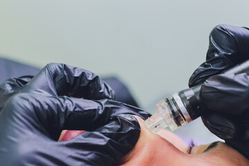 Woman cleaning nose skin pores using vacuum blackhead remover, cosmetic procedure.