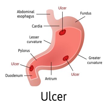 Peptic ulcer of the stomach, microscopic colorful anatomy on a white background. Medical vector illustration with all internal parts are marked with lines.