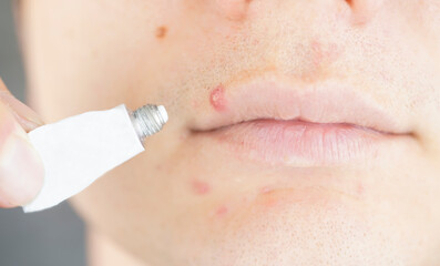 A tube of cream next to a large red acne on the lip. close-up shot