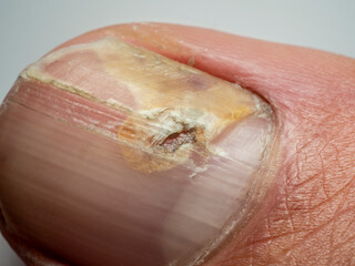 Nail infections caused by fungi such as: onychomycosis also known as tinea unguium. Thumb...