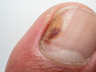 Fototapeta premium Nail infections caused by fungi such as: onychomycosis also known as tinea unguium. Thumb infection. Caused by dermatophytes and yeasts and for the concomitant antibacterial activity