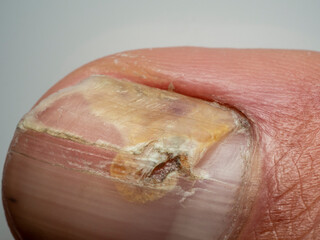 Nail infections caused by fungi such as: onychomycosis also known as tinea unguium. Thumb...