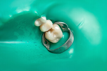Dentistry, caries treatment. Oral cavity with rubber dam and claimer, close-up.