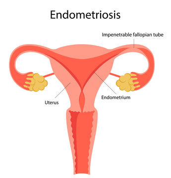 Impenetrable fallopian tube