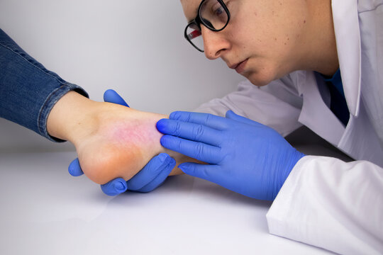 A woman in consultation with a vascular surgeon. A doctor examines a leg with swollen veins. Varicose veins on the leg
