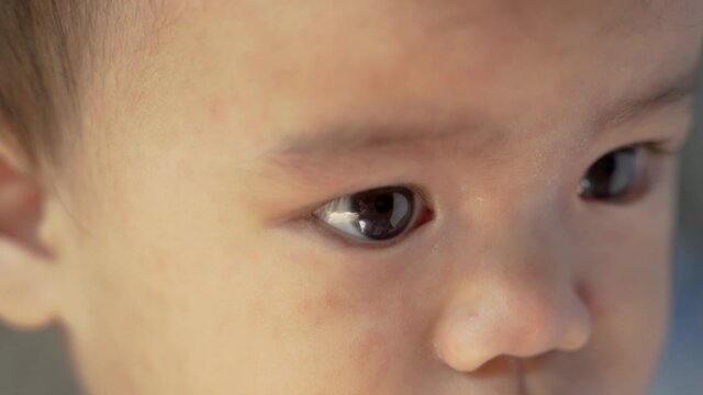 portrait of asian baby with skin rashes from allergies or irritation and itchy