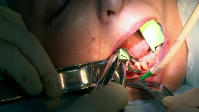 Stomatologist do tooth extraction a patient in modern office clinic operating room uses modern dental equipment and anesthesia. Close-up dental care oral and maxillofacial implant surgery.