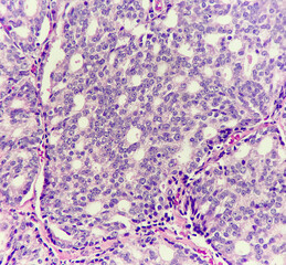 Photo of prostate cancer displays Gleason pattern 4, photo under light microscope, magnification 200x
