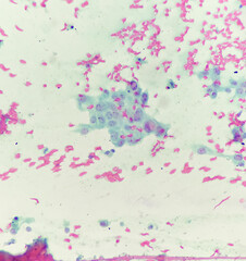 Cytology slide of thyroid cancer (papillary thyroid carcinoma) displays cancer cell with intranuclear pseudoinclusion, photo under light microscope, magnification 400x