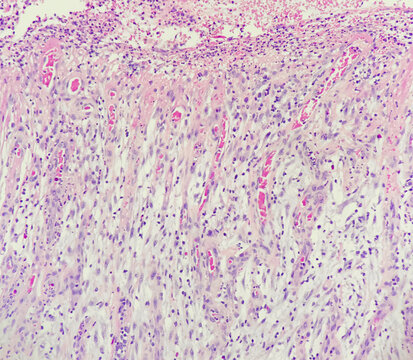 Photo of organizing inflammation, consisting of neovascularization, edematous change and several inflammatory infiltrates, photo under light microscope, magnification 200x