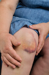 Closeup of bruise on the woman knee.Woman holding her knee after injury