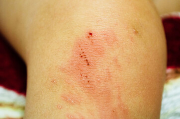 Abrasions on children's knees. Small child injury, scratch on knees, redness of knee