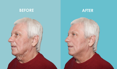 The male lifting before and after procedures