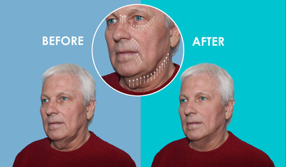 The male lifting before and after procedures