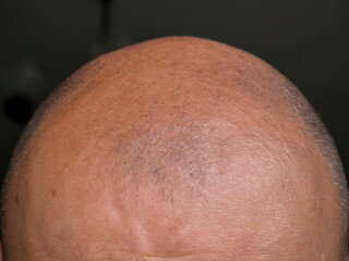 Fototapeta premium Human hair loss concept. Close up detail with a human head bald with alopecia.