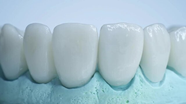 Panoramic close up view of dental implants in jaw with blue background. New white teeth are on a table in lab