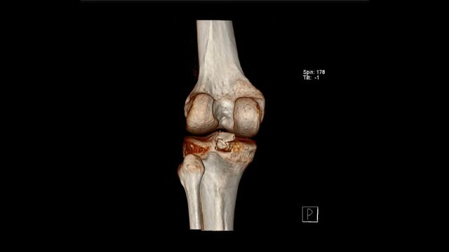 Radiology examination, Computed Tomography Volume Rendering examination of the  Knee joint ( CT VR Knee)