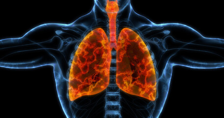 Human lungs medical illustration showing infected lungs in bright orange. 3D illustration