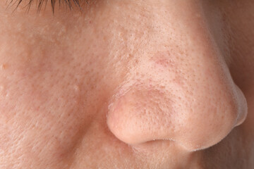 Fototapeta premium Greasy oily face and comedones, Skin problem with acne scar diseases, Close up woman face with blackhead pimples on nose.