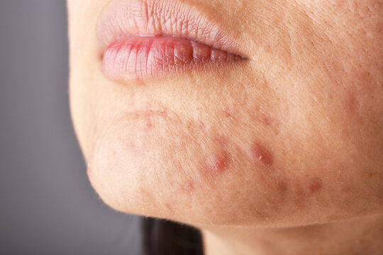 Skin Problem With Acne Diseases, Close Up Woman Face With Whitehead Pimples On Chin, Menstruation Breakout, Scar And Oily Greasy Face.