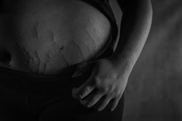 stomach stretch marks, black and white tummy marks
