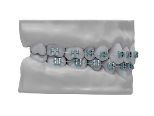 Human jaws with healthy teeth and classic metal braces, side view, isolated, 3d render