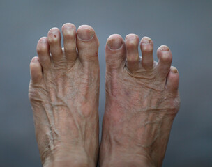 Aging human bare foot with veins