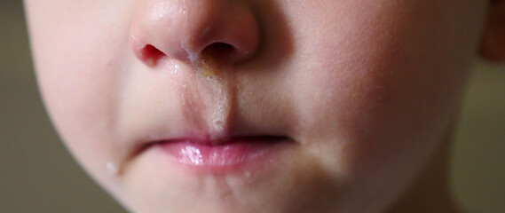 flu symptom and runny nose, nasal mucosa in children,