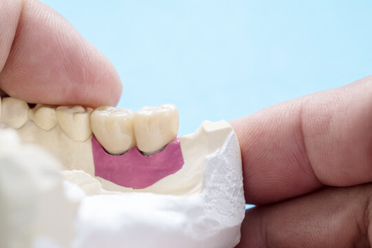 Closeup / Implant Prosthodontics or Prosthetic / Tooth crown and bridge implant dentistry equipment and model express fix restoration.