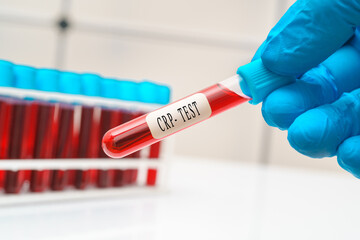 Blood sample   test tube in doctor hand for   C-reactive protein  CRP test