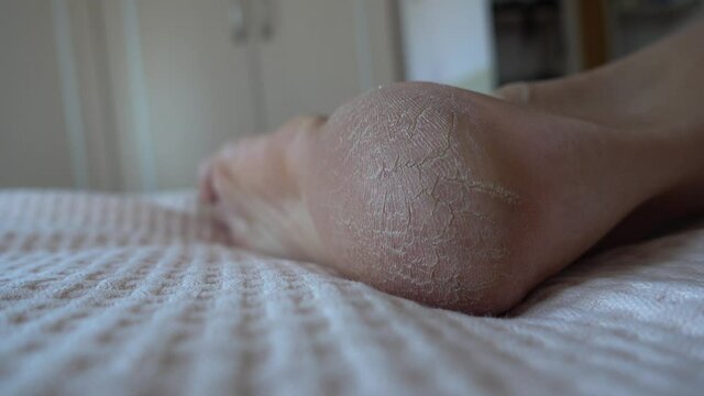 4K Close up Cracked heel of female sole needing peeling
