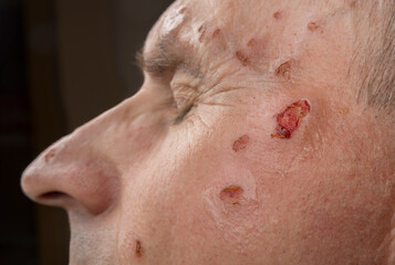 Naklejka premium Wound from laser on a face from dermatologist