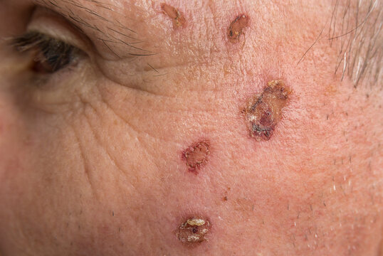 Wound from laser on a face from dermatologist