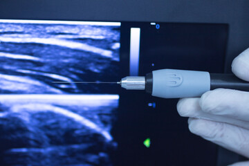 EPI dry needling ultrasound scan