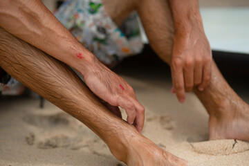 The guy got abrasions after an unsuccessful fall from the surf board. A wet guy on the shore examines an injured arm.
