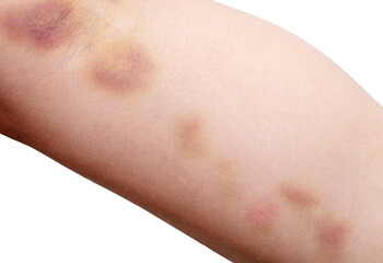 Closeup bruise on human skin on a white background. - obrazy, fototapety, plakaty
