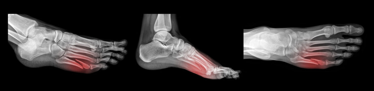 X-ray broken human foot. AP view. 3 views settings